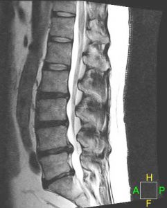 lumbar_discherniation_lat_241_300_80