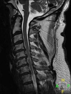 cervical_stenosis_lat2_228_300_80